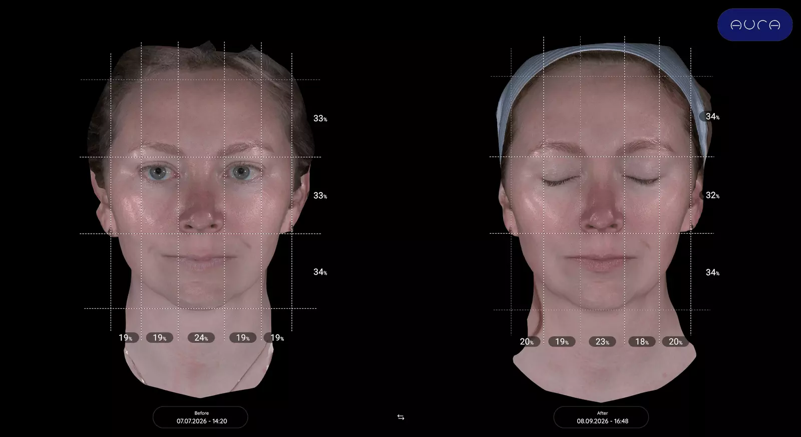 Aesthetic Enhancement: Exploring the Efficacy of XERF for Pre-Wedding Skin Rejuvenation
