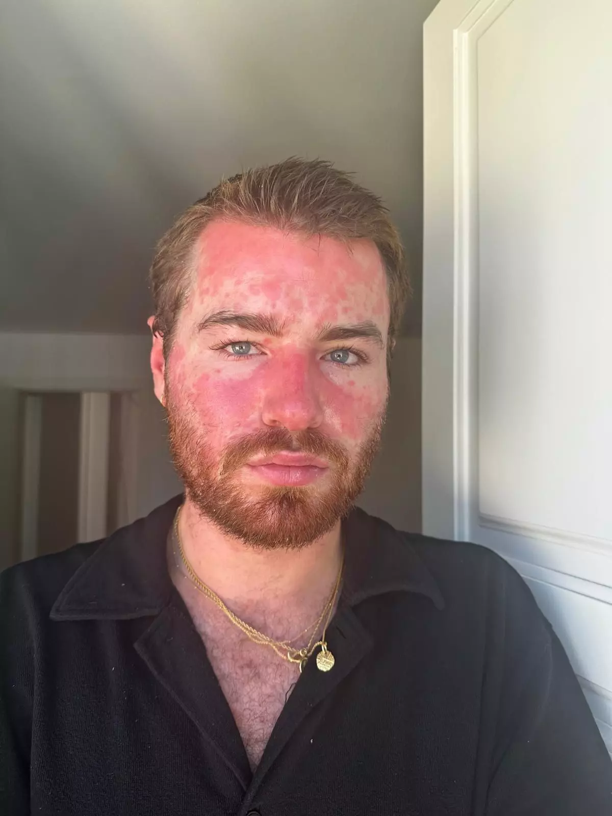 Exercising with Psoriasis: Embracing Activity and Self-Care